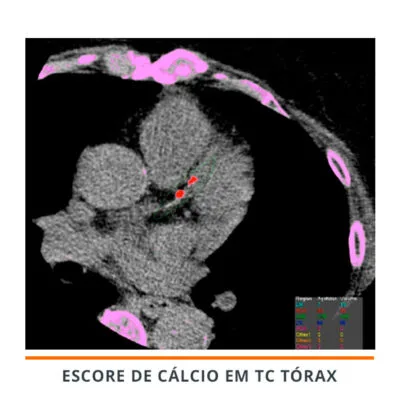 Escore de cálcio: o que é, como calcular e valores