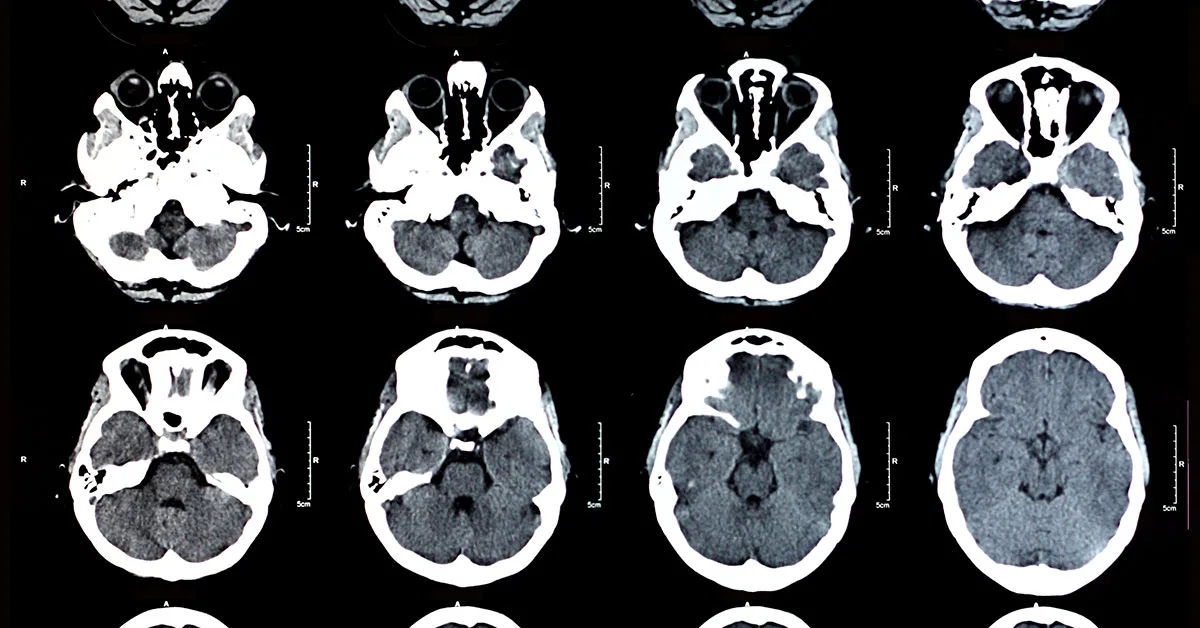 doencas investigadas pela tc do cranio doenças investigados pela tc de cranio