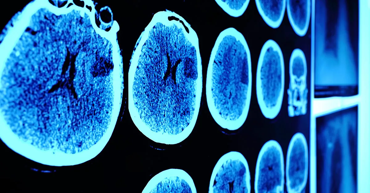 exame de tc do cranio exame de tc de cranio