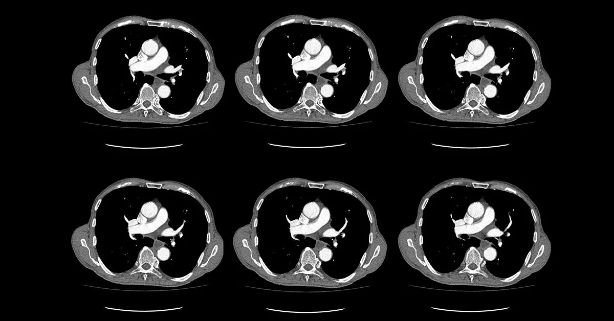 imagem de angio tc imagem de angio tc