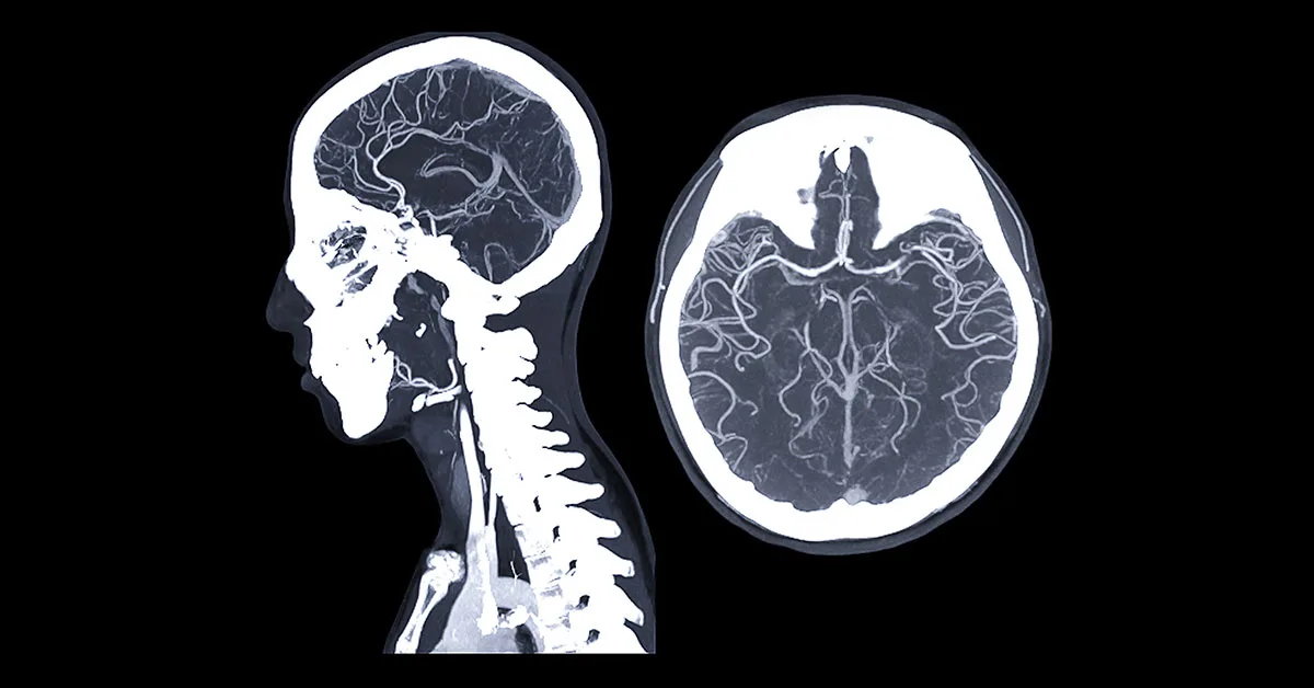 imagem de angiotomografia imagem de angiotomografia