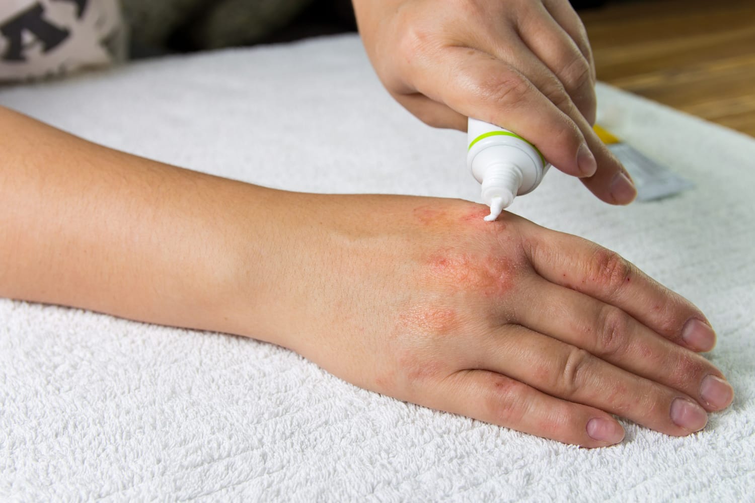 passando pomada na dermatite