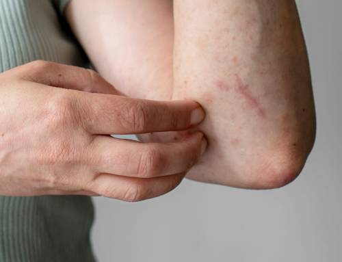 Dermatite: o que é, sintomas, tipos e como tratar